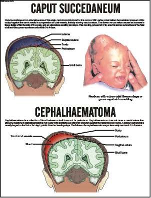 Caput Succedaneum / Cephalhaematoma