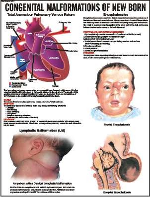 Congenital Malformations of New Born