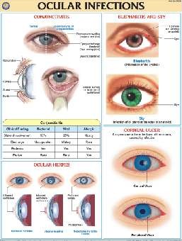 Ocular Infections