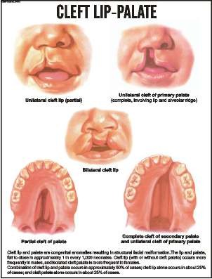 Cleft Lip-Palate
