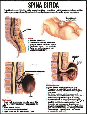 Spina Bifida