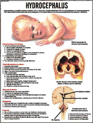 Hydrocephalus